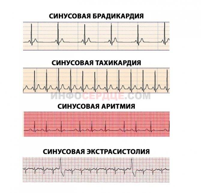 Что означает брадикардия в кардиограмме