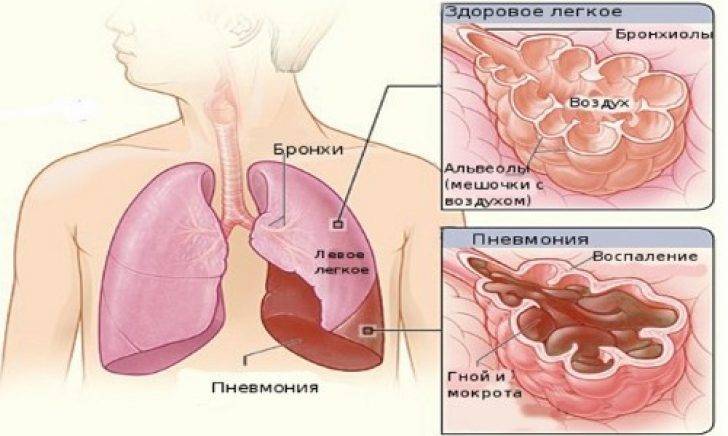Как отличить бронхит от пневмонии по симптомам и результатам диагностических исследований