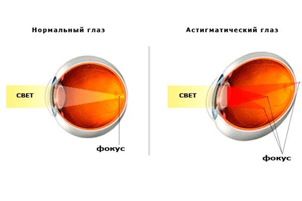 Сложный астигматизм бывает миопическим и гиперметропическим, что это за нарушение рефракции обоих глаз, его лечение и коррекция