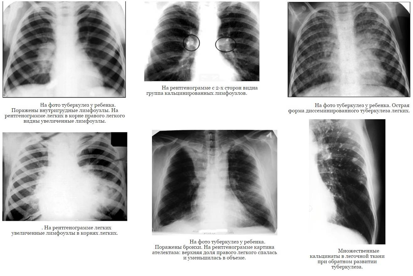 Признаки туберкулеза у детей: первые симптомы, на ранних стадиях, диагностика