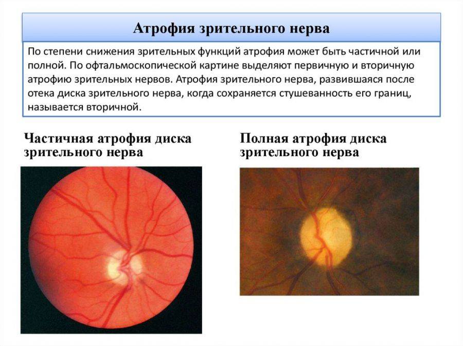 Атрофия зрительного нерва (оптическая нейропатия), методы лечения