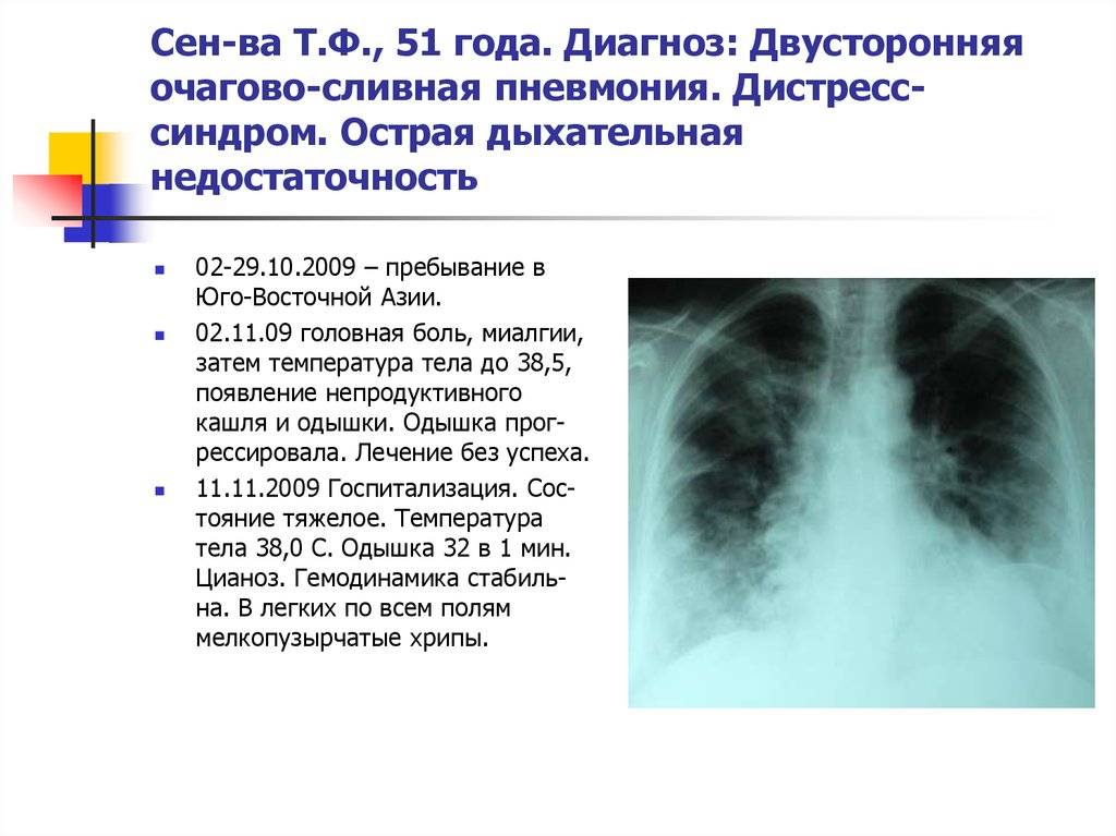Двусторонняя пневмония симптомы и лечение — proinfekcii.ru