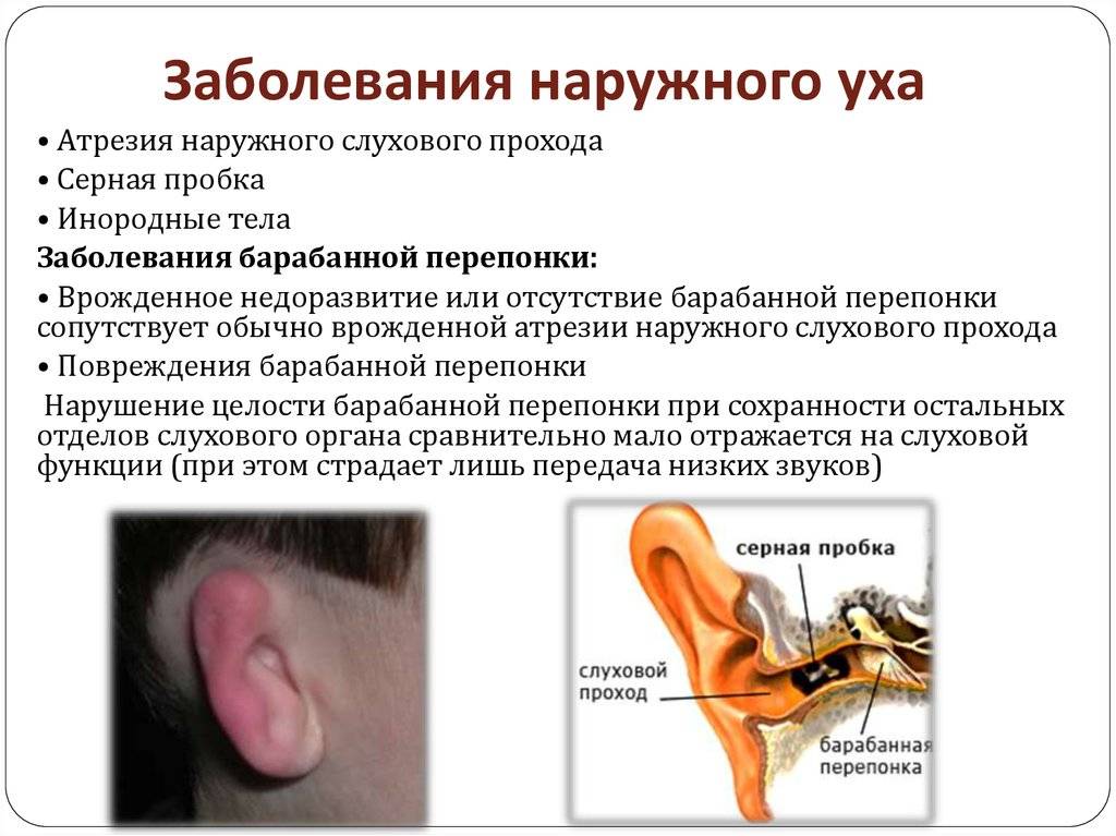 Отит среднего уха – лечение в домашних условиях