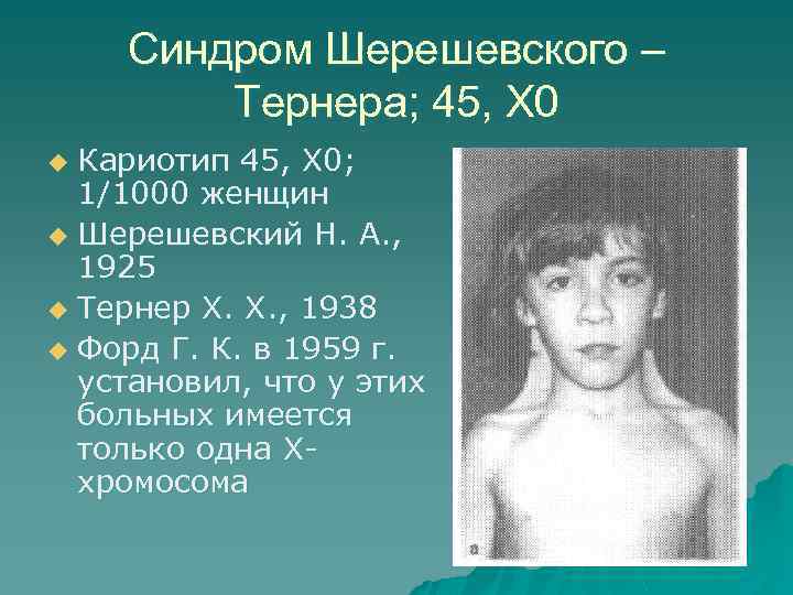 Все, что нужно знать о синдроме шерешевского-тернера | клиника "центр эко" в москве