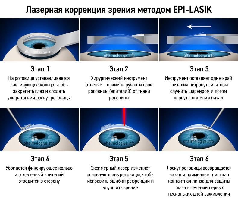 До и после лазерной коагуляции сетчатки глаза — что можно и что нельзя делать