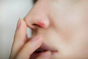 Простуда в носу — чем лечить, мазь от простуды в носу