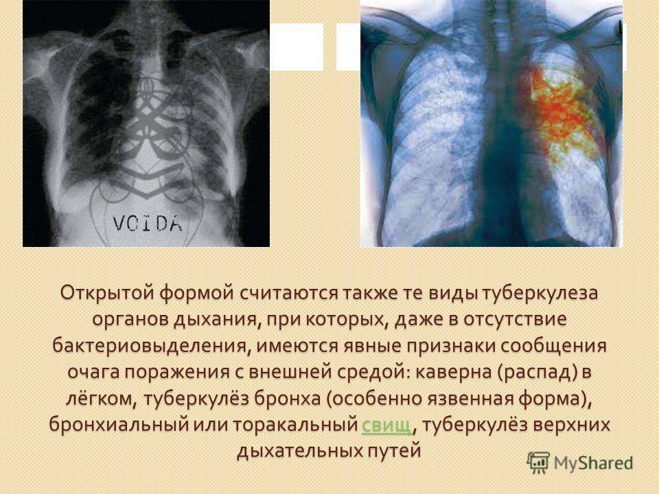Как заражаются туберкулезом легких – можно ли заразиться от больного человека на улице