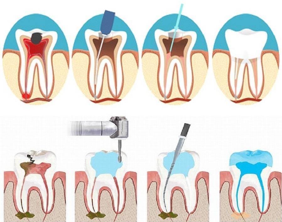 Как лечить кариес зубов в домашних условиях