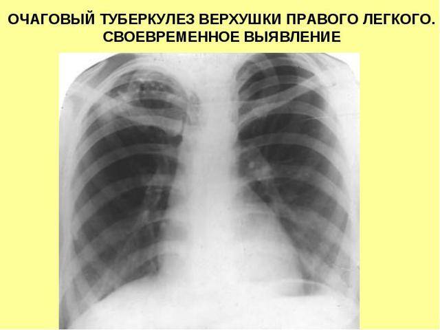 Очаговый туберкулез легких: заразен или нет, лечение, симптомы, сколько лечиться и как передается?