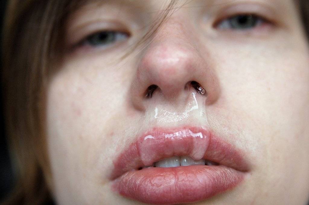 Из носа течет вода как лечить прозрачные сопли