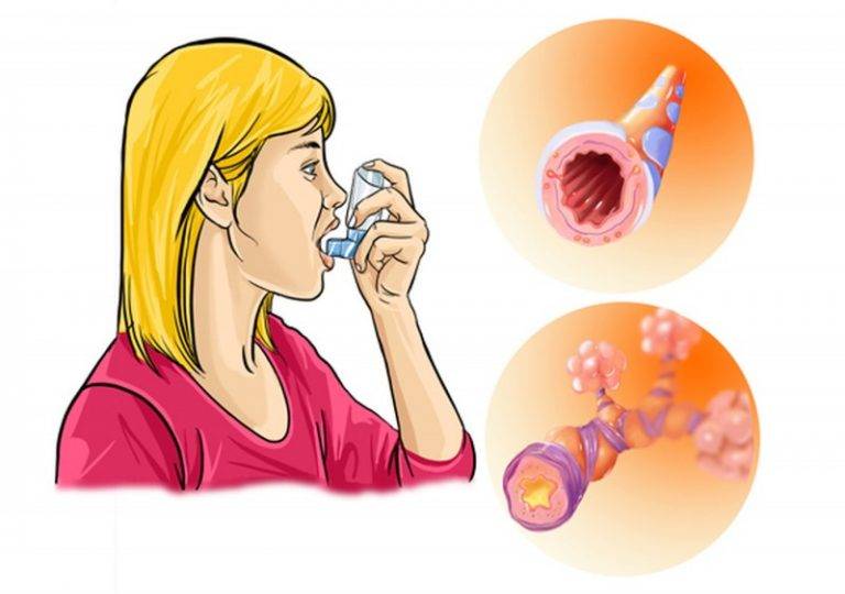 Лечение астмы народными средствами в домашних условиях