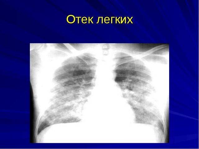 Пневмония на фоне сердечной недостаточности - доктор