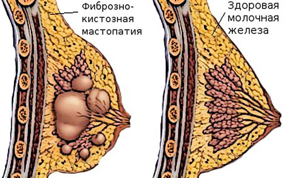 Что такое диффузная фиброзно-кистозная мастопатия и как ее лечить