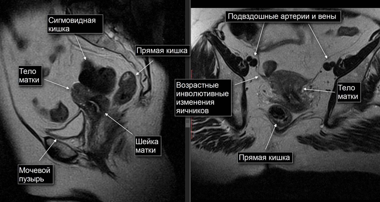 Мрт органов малого таза: что показывает, как подготовиться к томографии с контрастом?