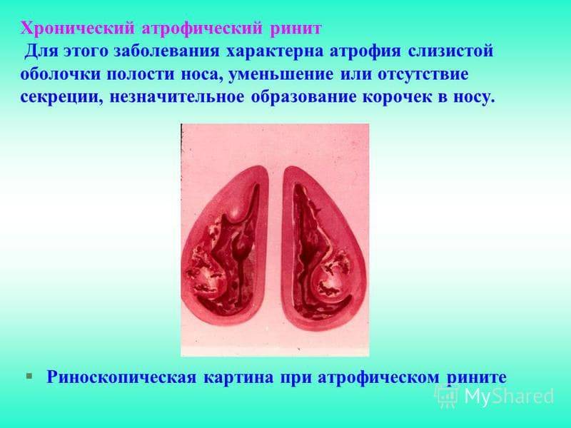 Хронический гипертрофический ринит: симптомы и лечение pulmono.ru
хронический гипертрофический ринит: симптомы и лечение