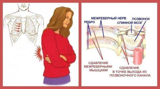 Межреберная невралгия слева у женщин: симптомы и лечение народными средствами