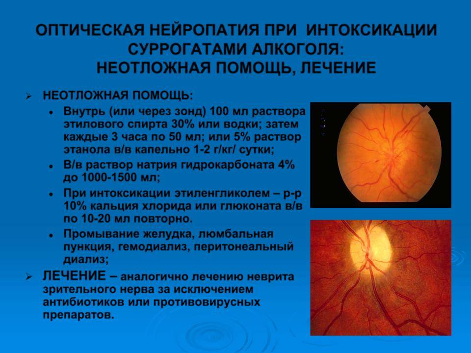 Частичная атрофия зрительного нерва (чазн)причины, диагностика и лечение