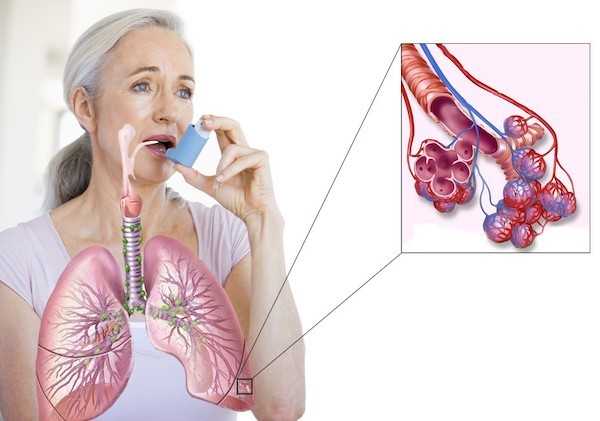 Как вылечить бронхиальную астму в домашних условиях – несколько вкусных и эффективных лекарств