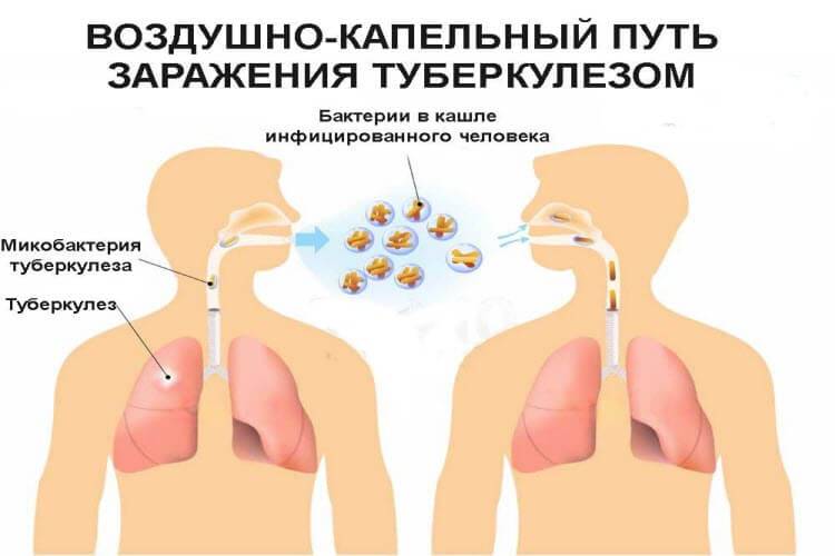 Опасна ли закрытая форма легочного туберкулеза?
