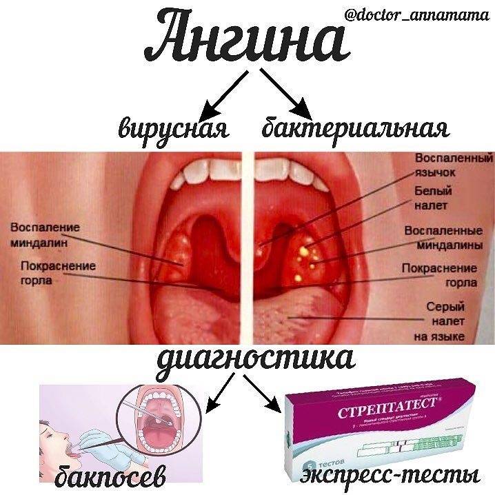 Бактериальный тонзиллит - лечение ангины: как лечить бактерии в горле и инфекцию, симптомы острого