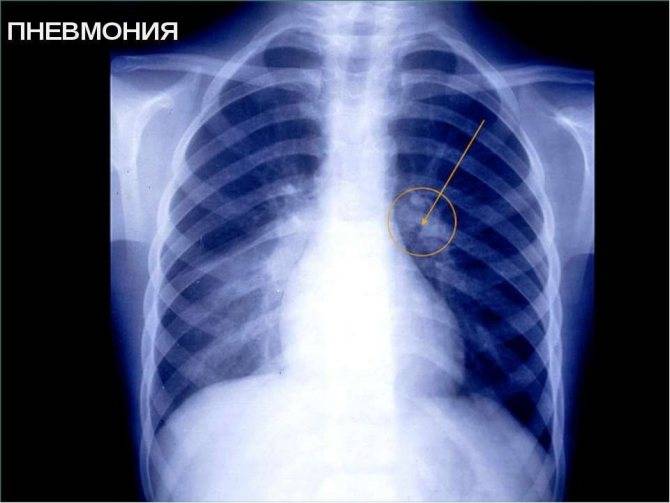 Пневмония(воспаление легких ) без кашля - симптомы и лечение
