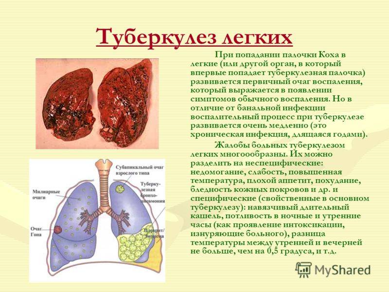 Виды туберкулеза и их особенности
