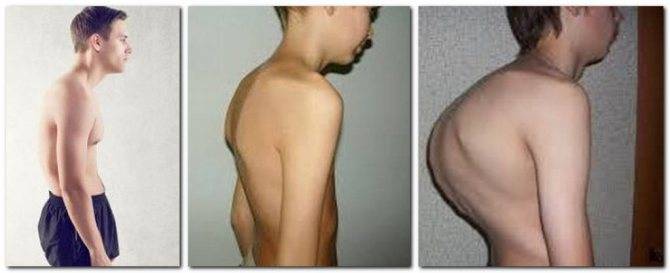 Кифоз грудного отдела позвоночника: массаж и упражнения, лфк и гимнастика, лечение в домашних условиях, симптомы грудного кифоза, что такое сглаженный кифоз