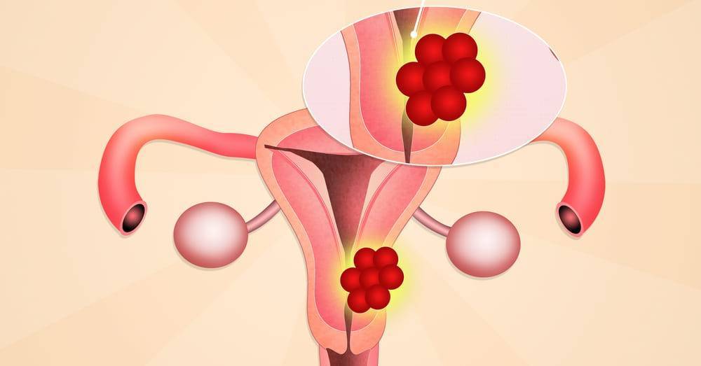 Эндометриоз и миома матки: симптомы и лечение