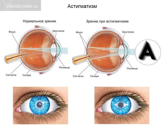 Миопический астигматизм: что это такое, лечение обоих глаз