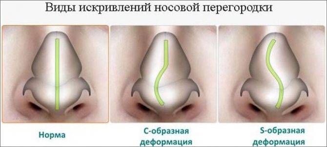 Искривление носовой перегородки: симптомы, как лечить смещение носа, последствия