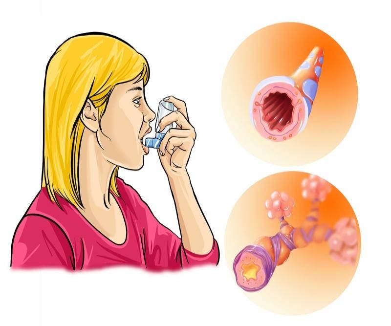Первые признаки астмы • аллергия и аллергические реакции