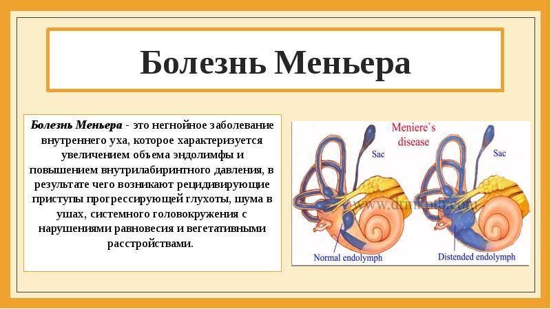 Синдром меньера: причины, проявления, диагностика, как лечить