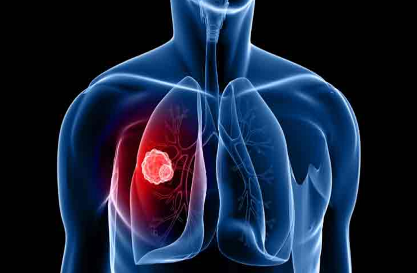 Параканкрозная пневмония при раке легких: симптомы, лечение и причины