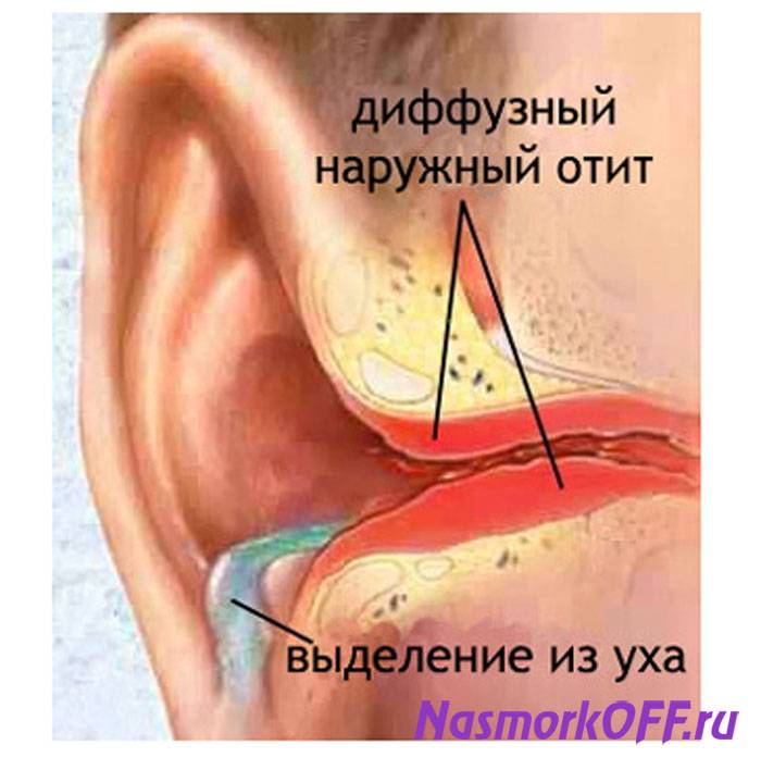 Отит - лечение у взрослых, как лечить острое воспаление среднего уха у взрослых, как быстро вылечить внутреннее