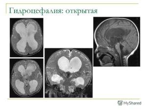 Наружная гидроцефалия головного мозга у взрослых: симптомы и лечение