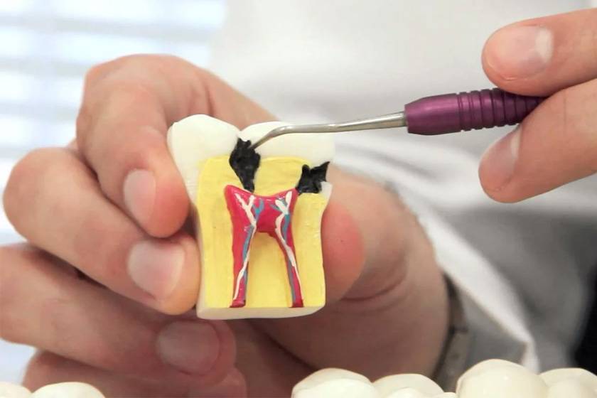 Депульпирование зуба перед протезированием: показания и противопоказания | za-rozhdenie.ru