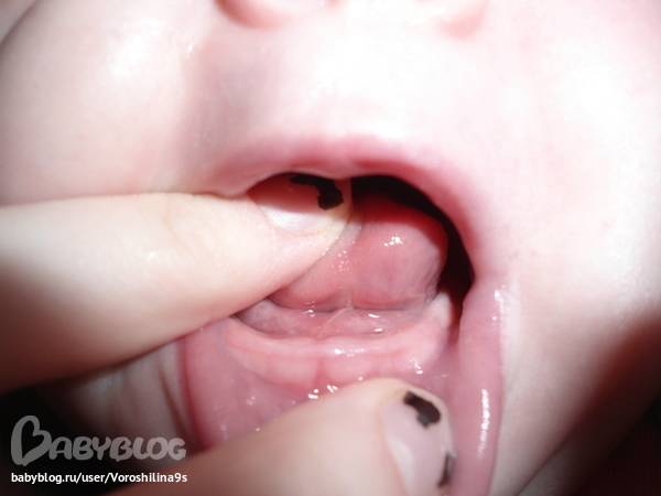 Сопли при прорезывании зубов, может ли быть насморк на зубы у детей, мнение комаровского