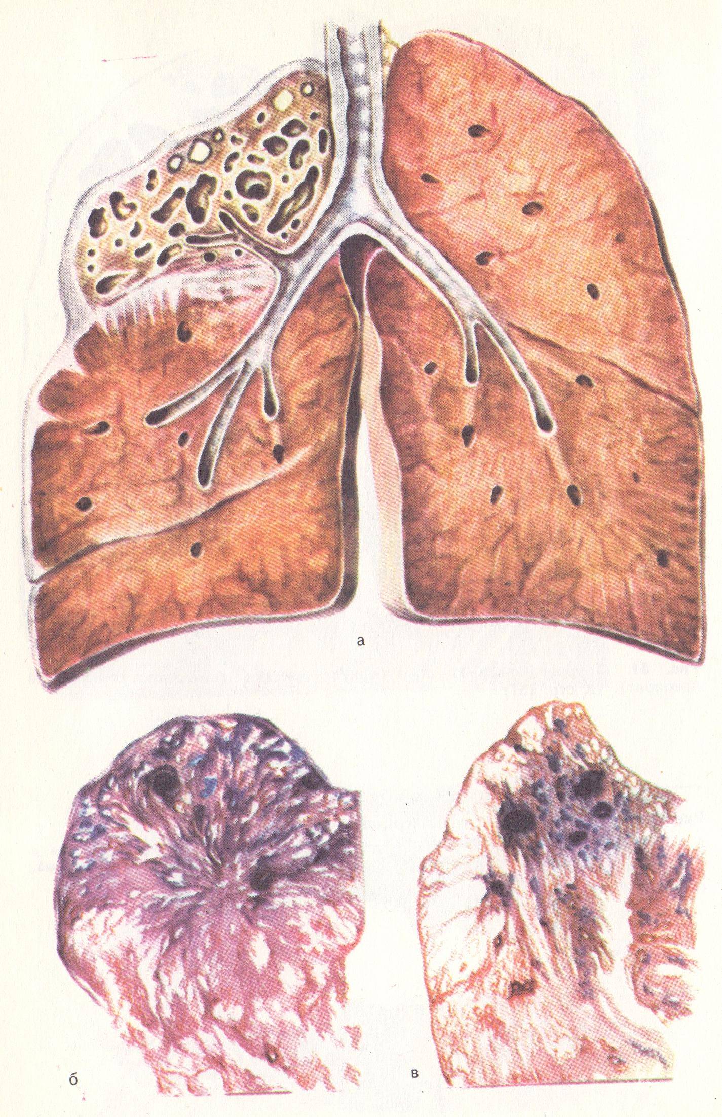Цирротический туберкулез кт