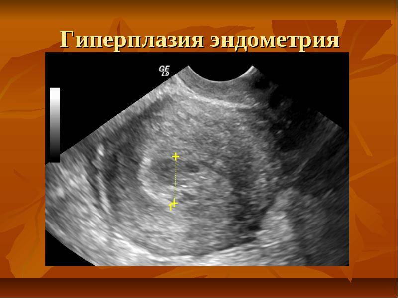 Железистая гиперплазия эндометрия | симптомы и лечение железистой гиперплазии эндометрия | компетентно о здоровье на ilive