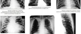Признаки туберкулеза у детей и первые симптомы