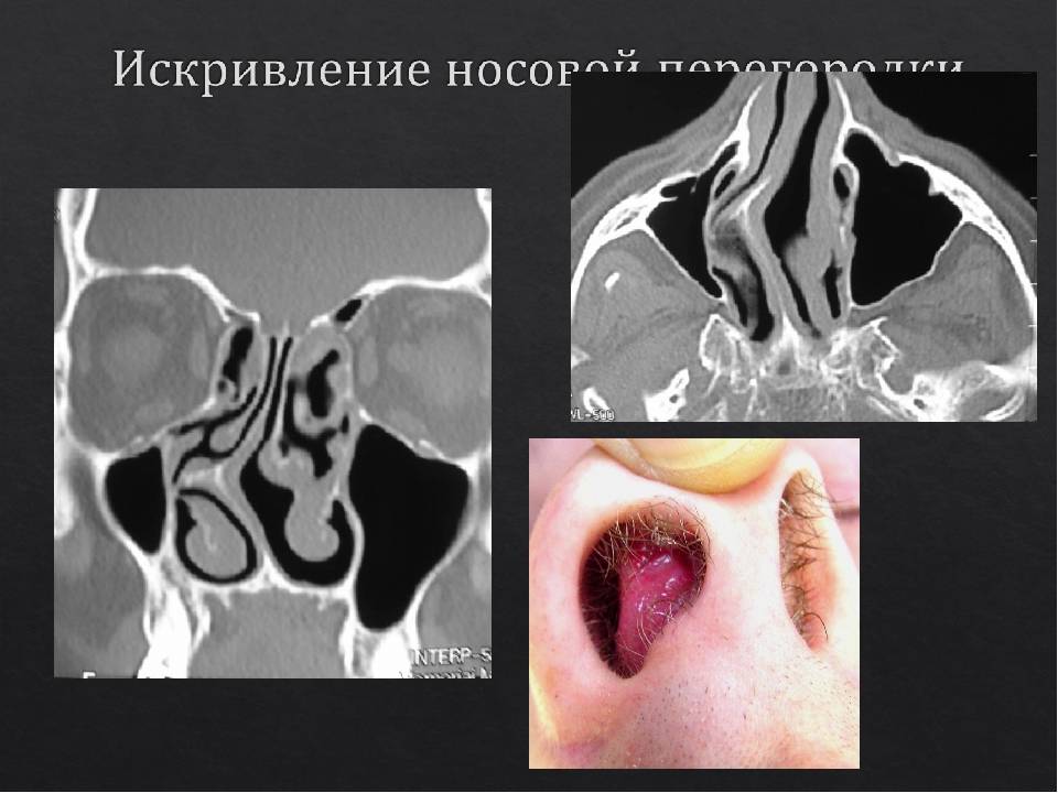 Атрофия слизистой носа: причины, симптомы и лечение