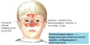 Гайморит у детей: признаки, симптомы и лечение