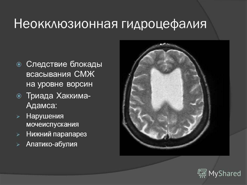 Наружная гидроцефалия головного мозга: что это такое, признаки, как лечить