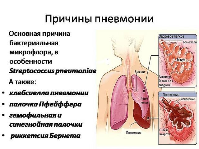 Причины возникновения пневмонии