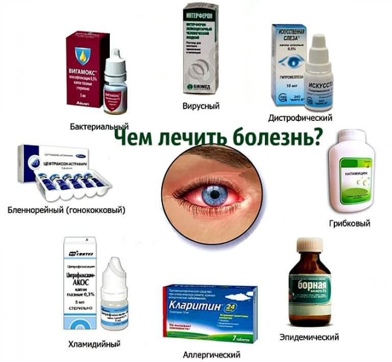 Конъюнктивит бактериальный - быстрое лечение глаз у взрослых
