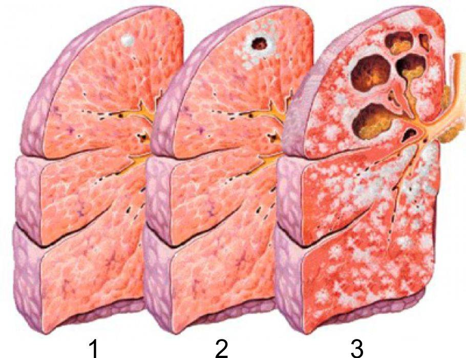 Как проявляется туберкулез легких, через какое время у взрослых на ранней стадии, как диагностировать открытую и закрытую форму