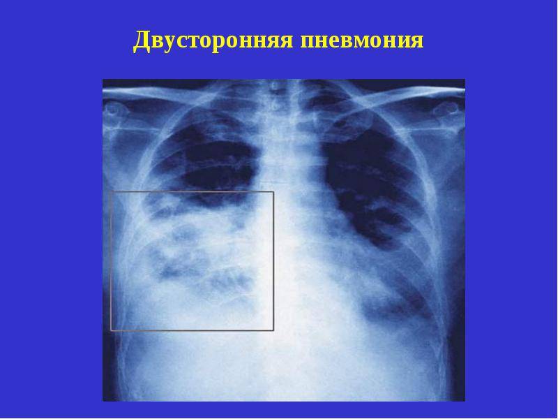 Двухсторонняя пневмония легких у взрослого - симптомы и последствия