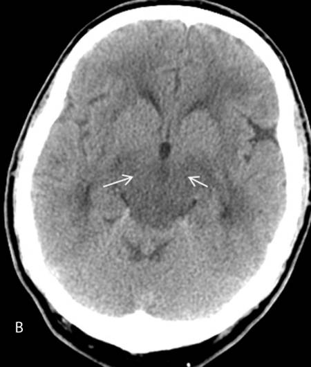 Резидуальная энцефалопатия головного мозга: что это такое, симптомы, лечение