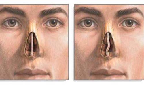 Искривление перегородки носа мкб-10: чем опасна деформация и смещение перегородок - мед-часть