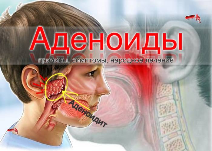 Аденоидит у ребенка - симптомы и лечение если жидкость в ушах при аденоидах